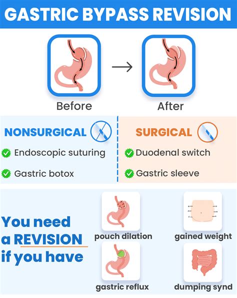 the gastric bypass revision